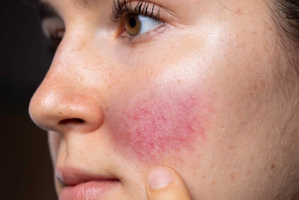 What’s the Difference Between Eczema and Rosacea