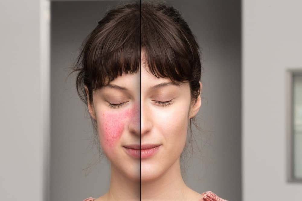 What’s the Difference Between Eczema and Rosacea