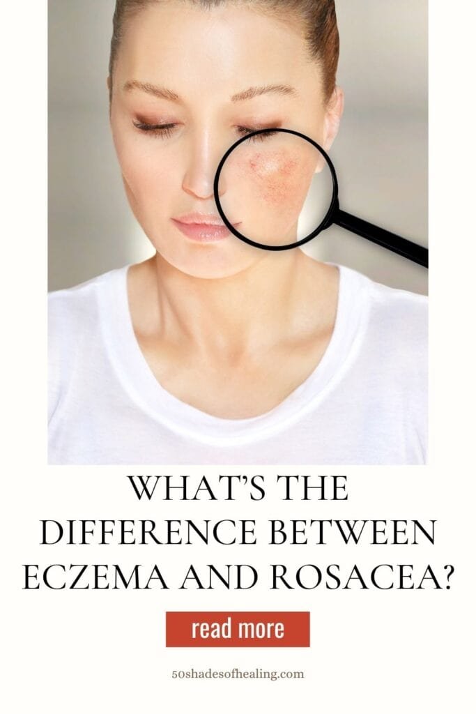 What’s the Difference Between Eczema and Rosacea